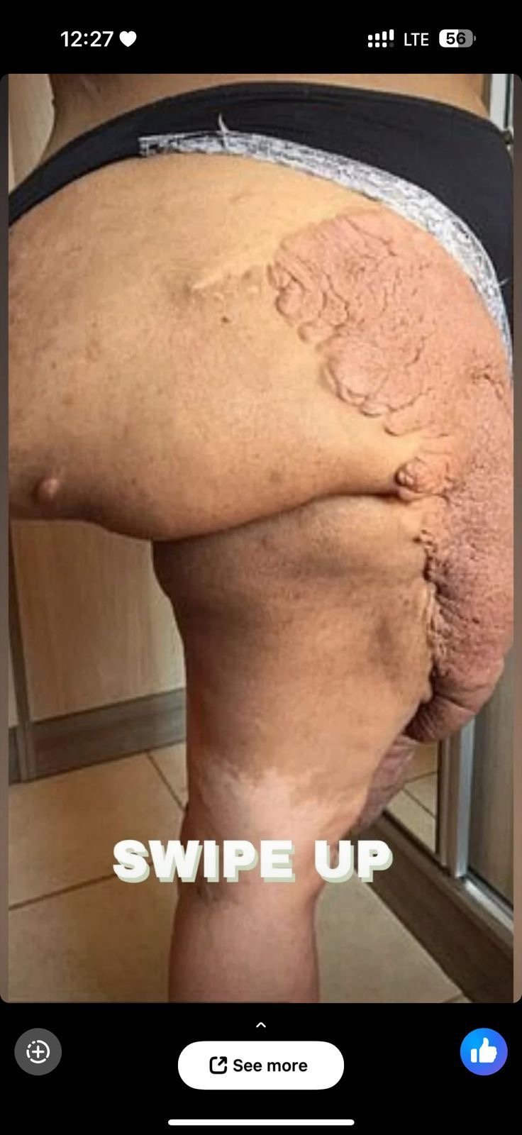 Body Acne: 4 Tips To Get Rid Of Them