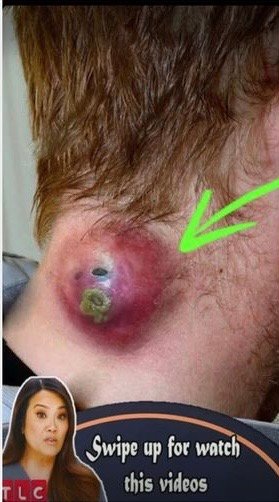Seven Things That Clog Your Pores And Cause Acne